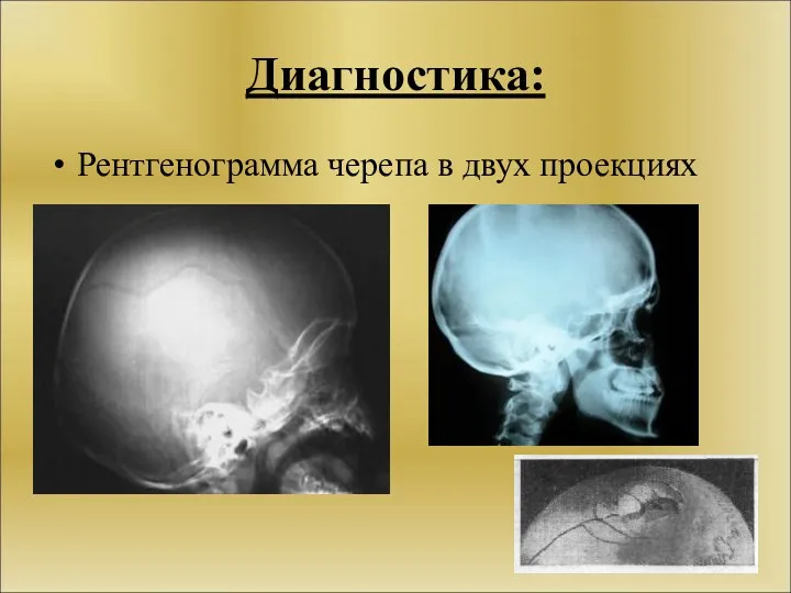 Диагностика: Рентгенограмма черепа в двух проекциях
