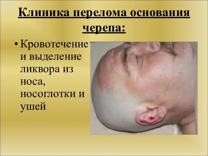 Клиника перелома основания черепа: Кровотечение и выделение ликвора из носа, носоглотки и ушей