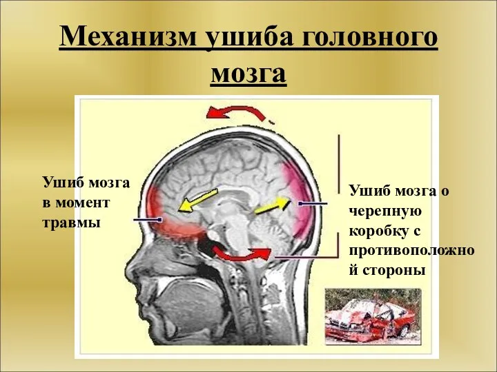 Механизм ушиба головного мозга Ушиб мозга о черепную коробку с