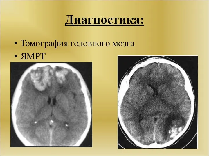 Диагностика: Томография головного мозга ЯМРТ