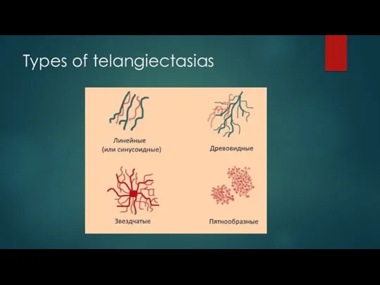 Types of telangiectasias