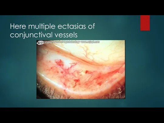 Here multiple ectasias of conjunctival vessels