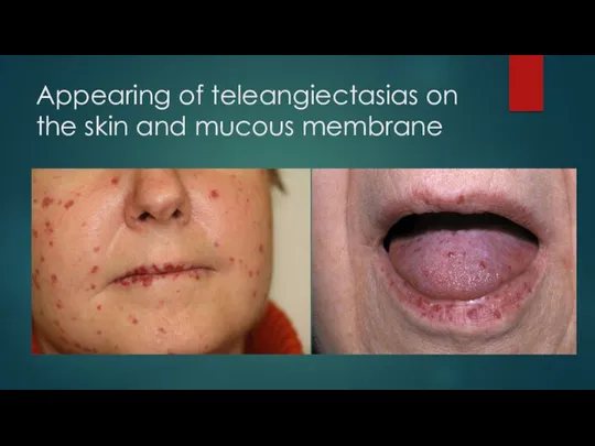 Appearing of teleangiectasias on the skin and mucous membrane