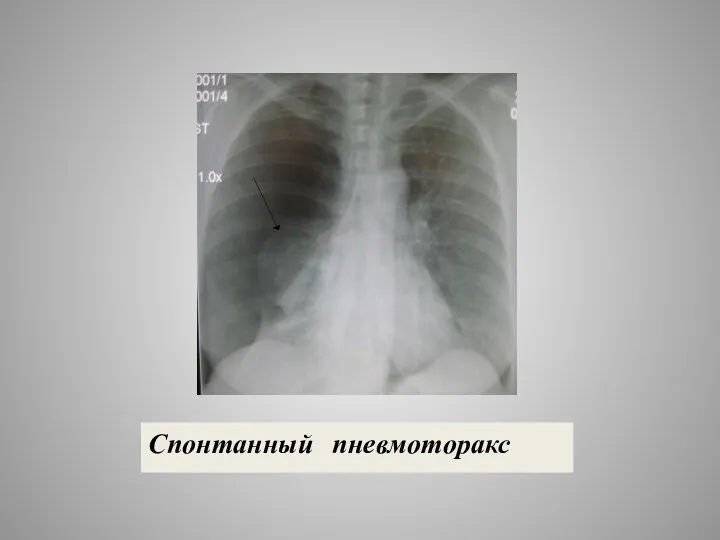 Спонтанный пневмоторакс