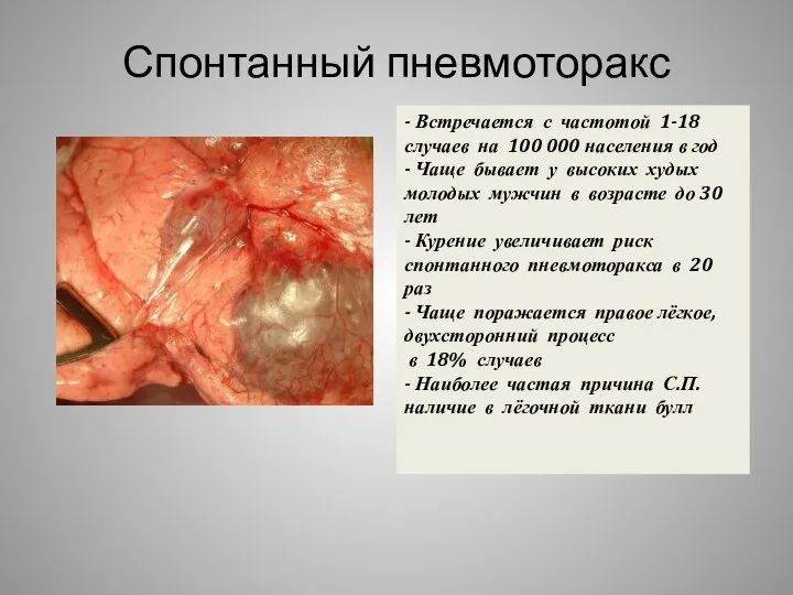 Спонтанный пневмоторакс - Встречается с частотой 1-18 случаев на 100