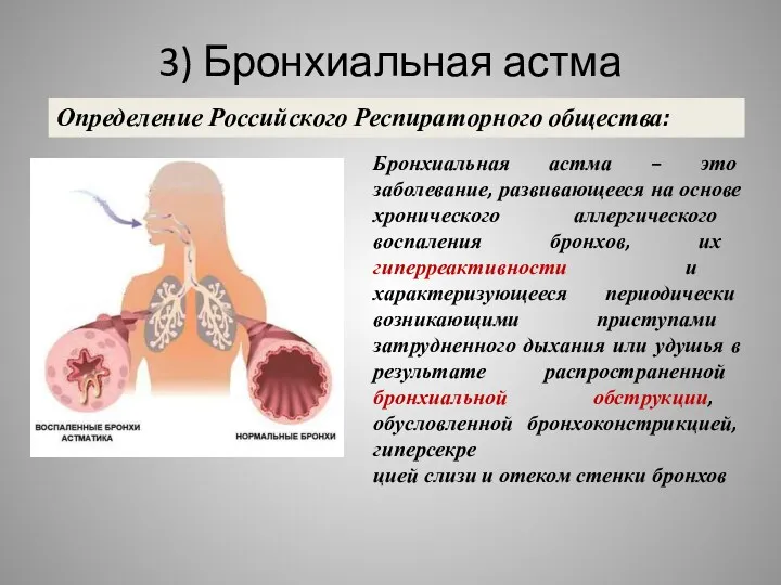 3) Бронхиальная астма Определение Российского Респираторного общества: Бронхиальная астма – это заболевание, развивающееся