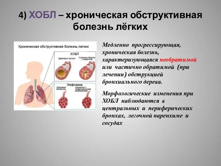 4) ХОБЛ – хроническая обструктивная болезнь лёгких Медленно прогрессирующая, хроническая