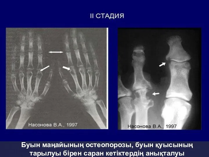 Буын маңайының остеопорозы, буын қуысының тарылуы бірен саран кетіктердің анықталуы