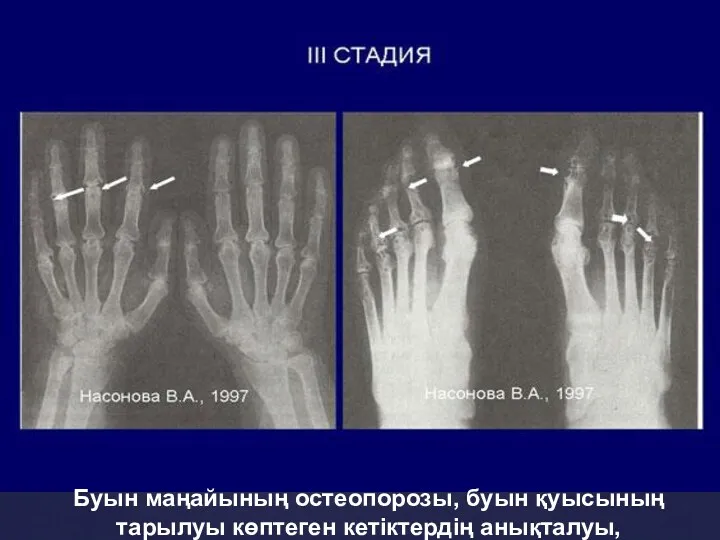 Буын маңайының остеопорозы, буын қуысының тарылуы көптеген кетіктердің анықталуы,