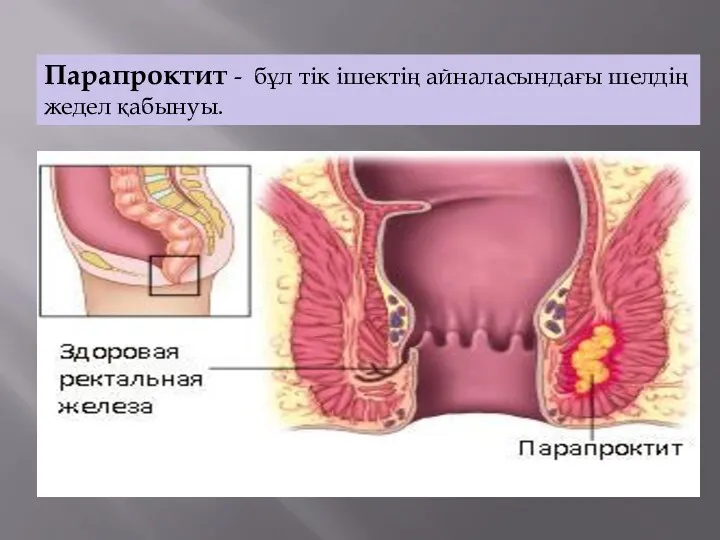 Парапроктит - бұл тік ішектің айналасындағы шелдің жедел қабынуы.