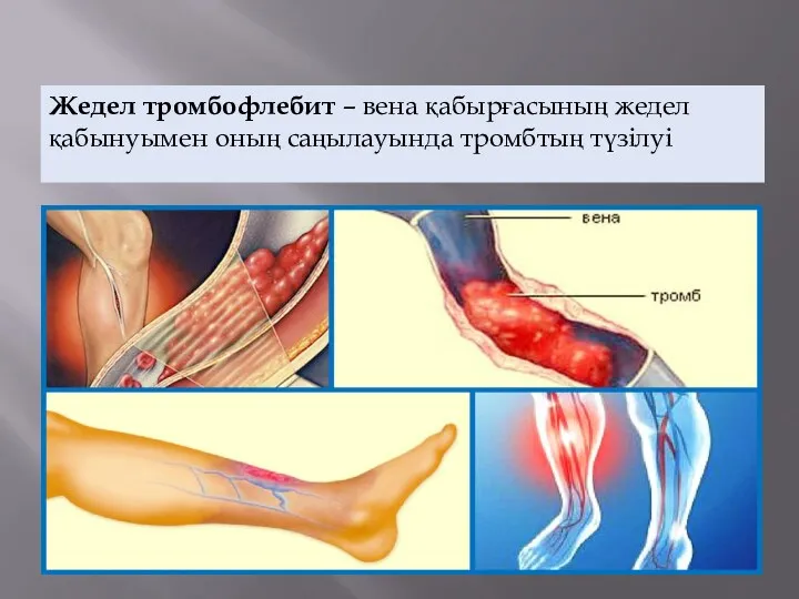 Жедел тромбофлебит – вена қабырғасының жедел қабынуымен оның саңылауында тромбтың түзілуі