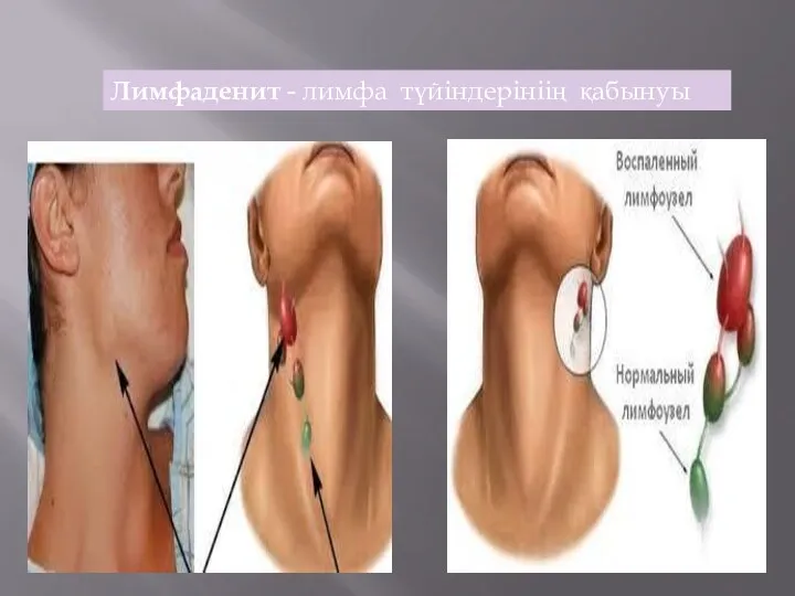 Лимфаденит - лимфа түйіндерініің қабынуы