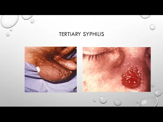 TERTIARY SYPHILIS