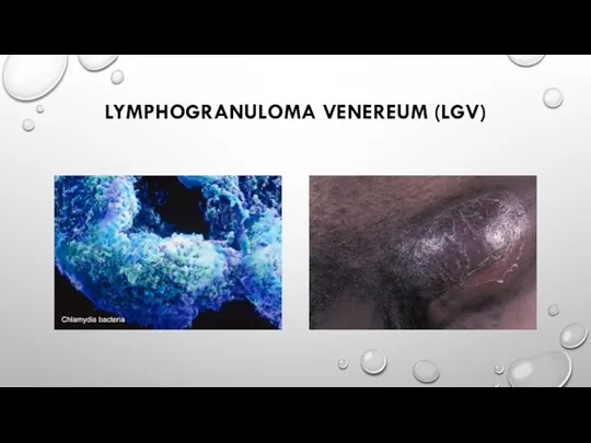 LYMPHOGRANULOMA VENEREUM (LGV)