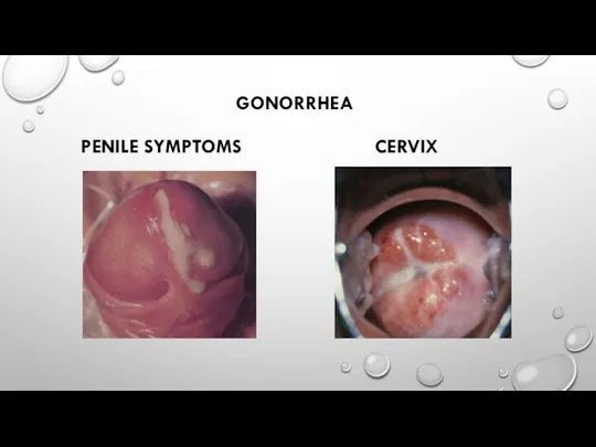 GONORRHEA PENILE SYMPTOMS CERVIX