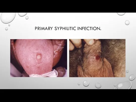 PRIMARY SYPHILITIC INFECTION.