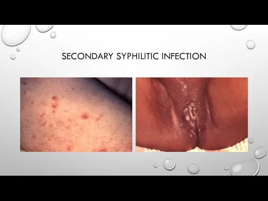 SECONDARY SYPHILITIC INFECTION