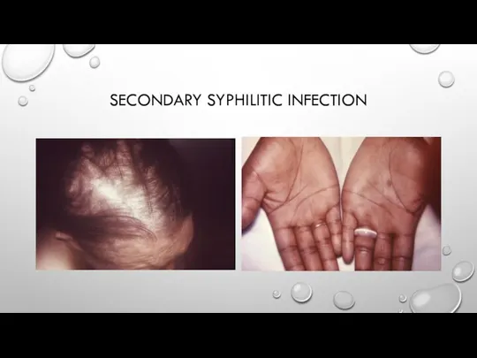 SECONDARY SYPHILITIC INFECTION