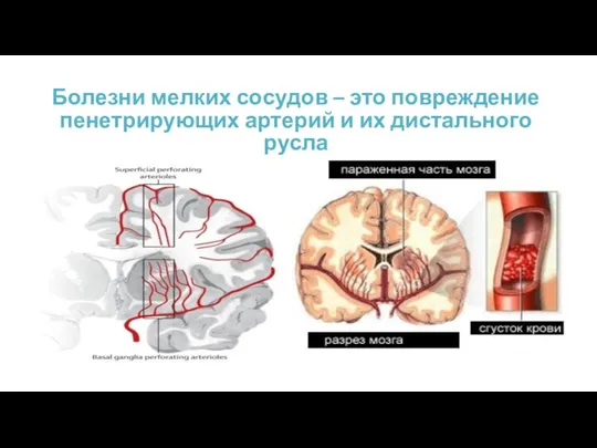 Болезни мелких сосудов – это повреждение пенетрирующих артерий и их дистального русла