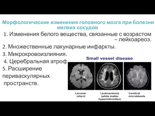 Морфологические изменения головного мозга при болезни мелких сосудов 1. Изменения