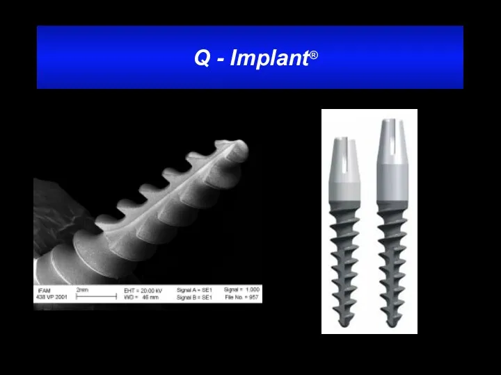 Q - Implant®