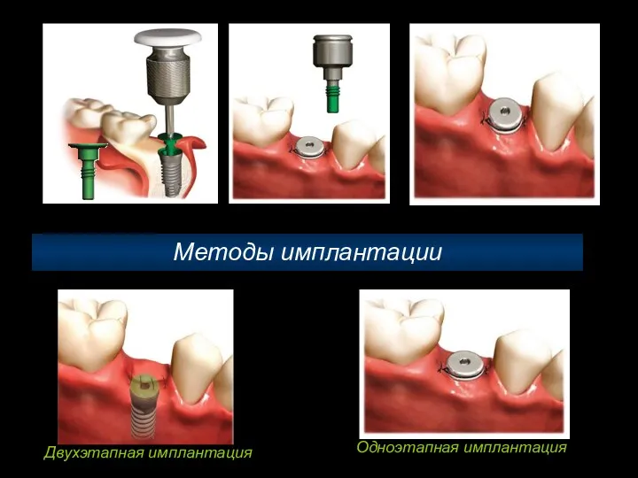 Методы имплантации Двухэтапная имплантация Одноэтапная имплантация