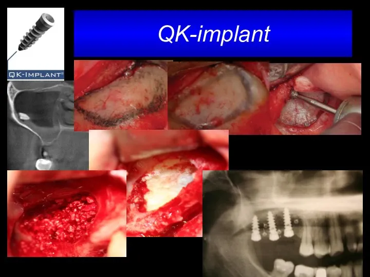 QK-implant