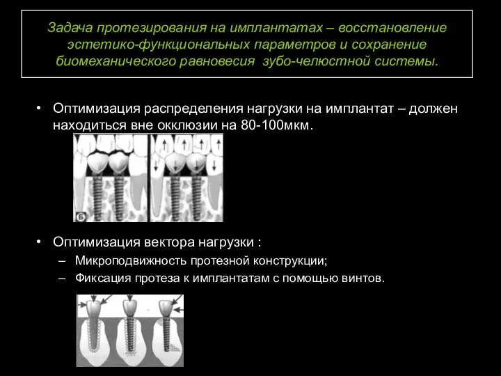 Задача протезирования на имплантатах – восстановление эстетико-функциональных параметров и сохранение биомеханического равновесия зубо-челюстной