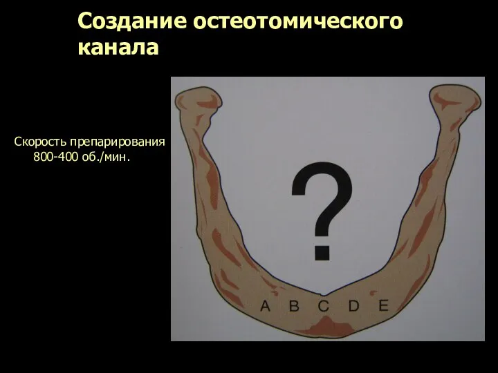 Создание остеотомического канала Скорость препарирования 800-400 об./мин.