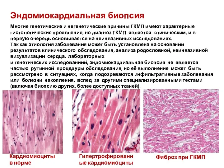 Эндомиокардиальная биопсия Многие генетические и негенетические причины ГКМП имеют характерные