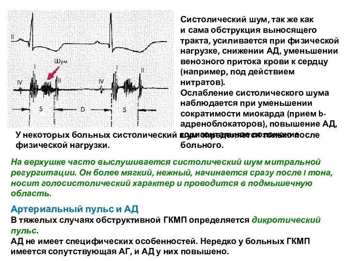 Систолический шум, так же как и сама обструкция выносящего тракта,