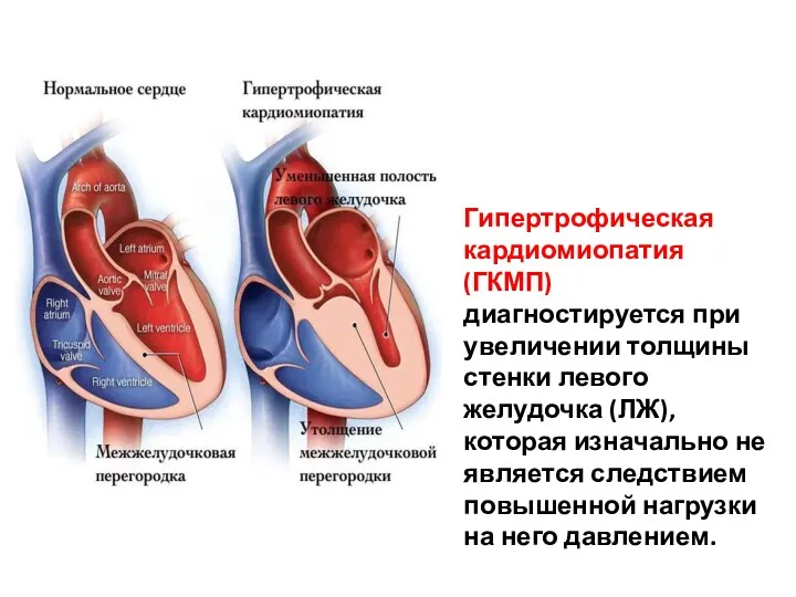 Гипертрофическая кардиомиопатия (ГКМП) диагностируется при увеличении толщины стенки левого желудочка