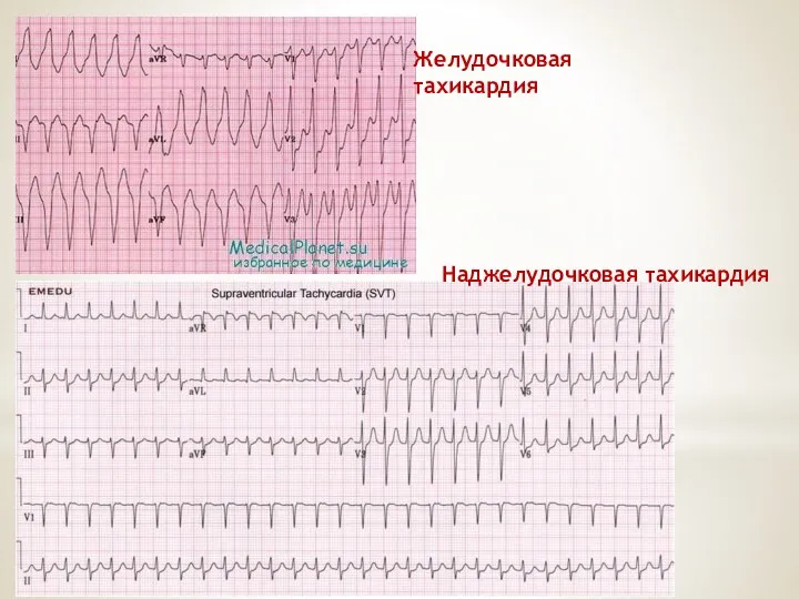 Желудочковая тахикардия Наджелудочковая тахикардия