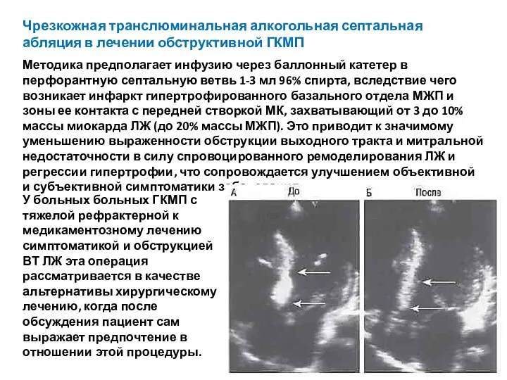 Чрезкожная транслюминальная алкогольная септальная абляция в лечении обструктивной ГКМП Методика