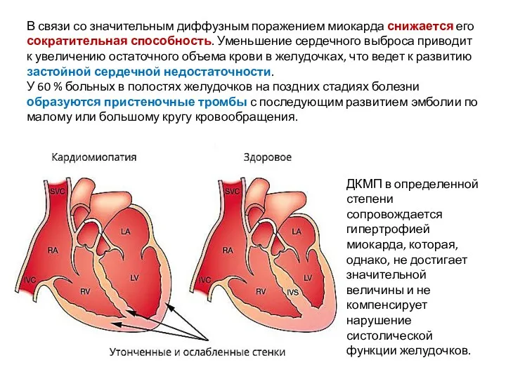 В связи со значительным диффузным поражением миокарда снижается его сократительная