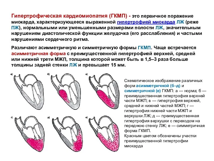 Гипертрофическая кардиомиопатия (ГКМП) - это первичное поражение миокарда, характеризующееся выраженной