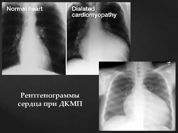 Рентгенограммы сердца при ДКМП