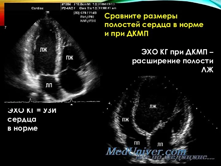 ЭХО КГ при ДКМП – расширение полости ЛЖ ЛЖ ПЖ