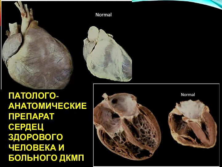 ПАТОЛОГО-АНАТОМИЧЕСКИЕ ПРЕПАРАТ СЕРДЕЦ ЗДОРОВОГО ЧЕЛОВЕКА И БОЛЬНОГО ДКМП
