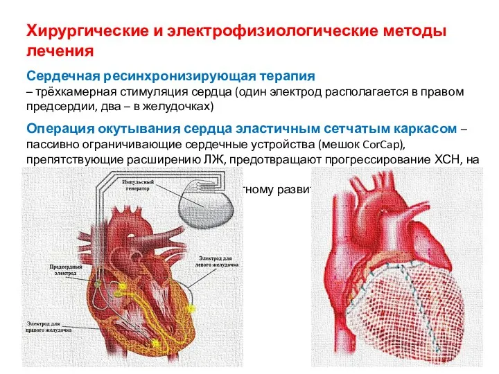 Хирургические и электрофизиологические методы лечения Сердечная ресинхронизирующая терапия – трёхкамерная