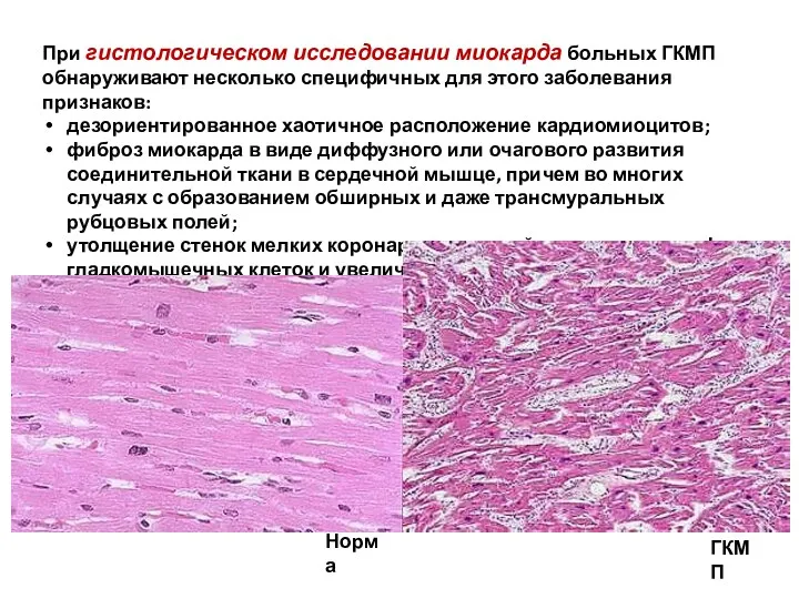 При гистологическом исследовании миокарда больных ГКМП обнаруживают несколько специфичных для