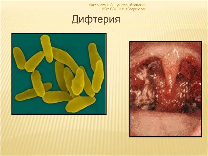 Макарьева Н.А. - учитель биологии МОУ СОШ №1 г.Георгиевск Дифтерия