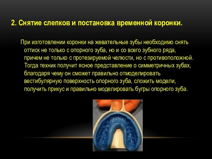 2. Снятие слепков и постановка временной коронки. При изготовлении коронки