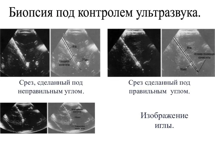 Срез, сделанный под неправильным углом. Срез сделанный под правильным углом. Изображение иглы. Биопсия под контролем ультразвука.