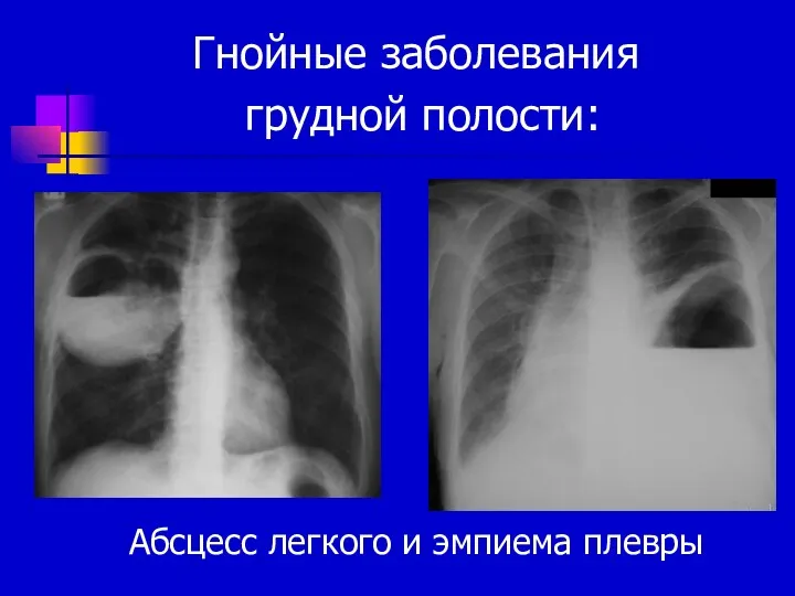 Гнойные заболевания грудной полости: Абсцесс легкого и эмпиема плевры