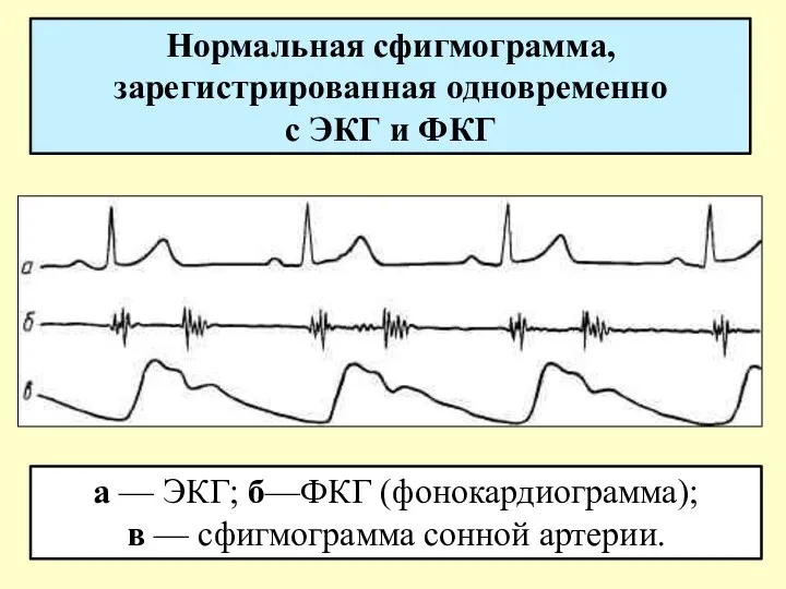 Нормальная сфигмограмма, зарегистрированная одновременно с ЭКГ и ФКГ а —