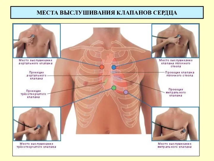 МЕСТА ВЫСЛУШИВАНИЯ КЛАПАНОВ СЕРДЦА