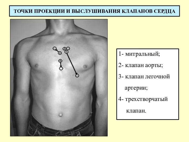 ТОЧКИ ПРОЕКЦИИ И ВЫСЛУШИВАНИЯ КЛАПАНОВ СЕРДЦА 1- митральный; 2- клапан