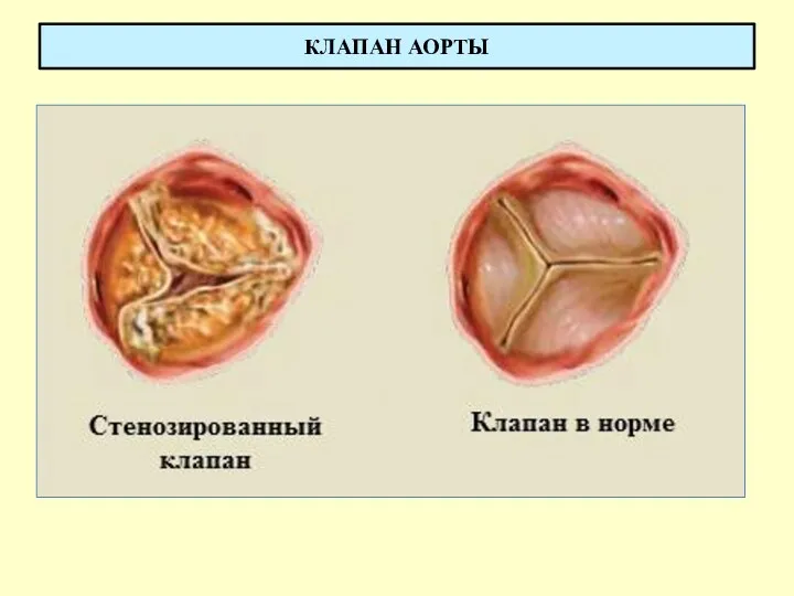 КЛАПАН АОРТЫ