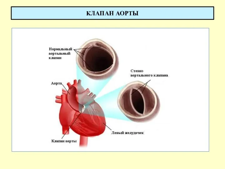 КЛАПАН АОРТЫ